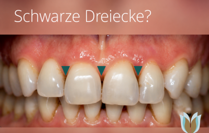 Schwarze Dreiecke – wird dein Lächeln zum Bermudadreieck?